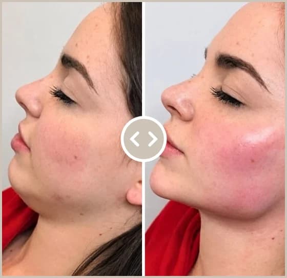 Résultat d'un traitement de l'ovale du visage