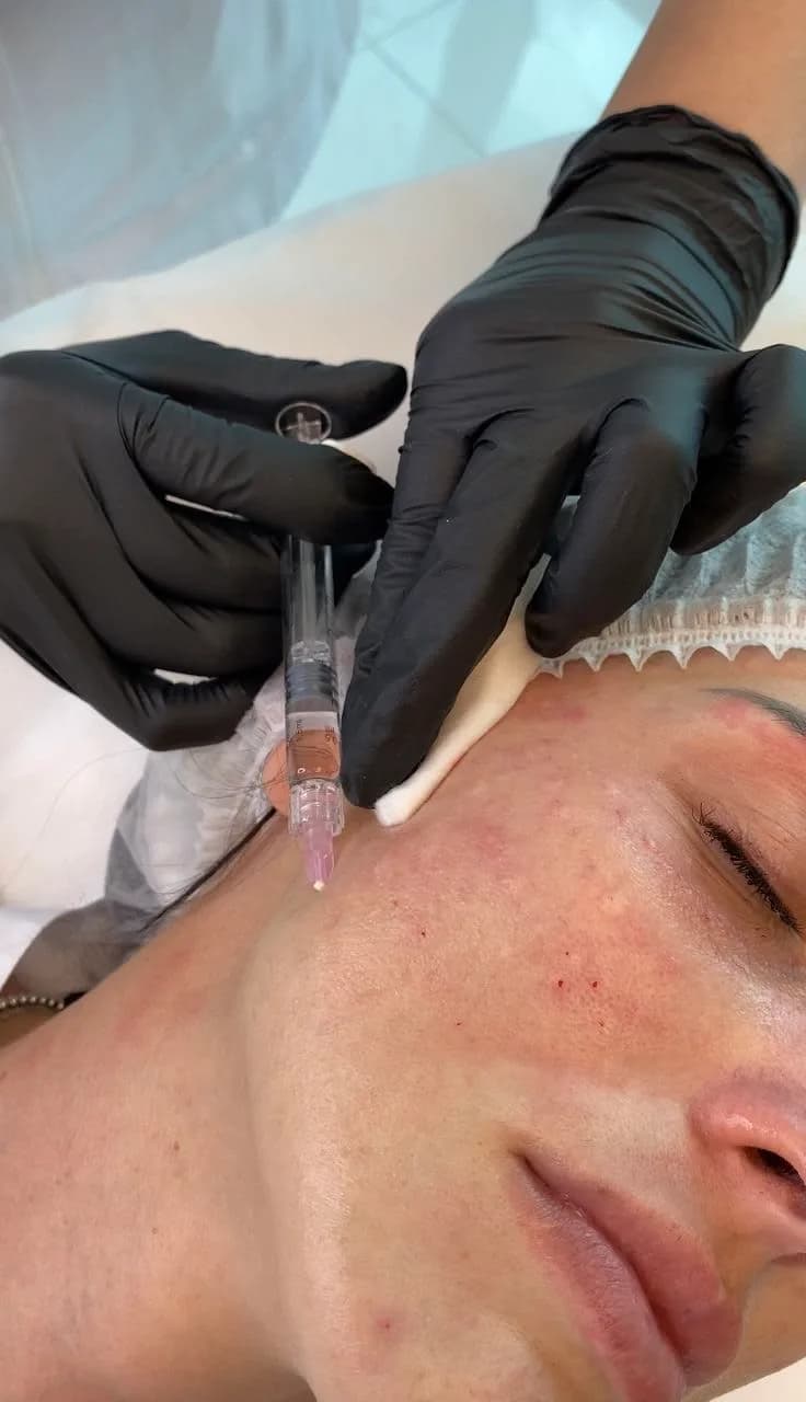 Mésothérapie du visage